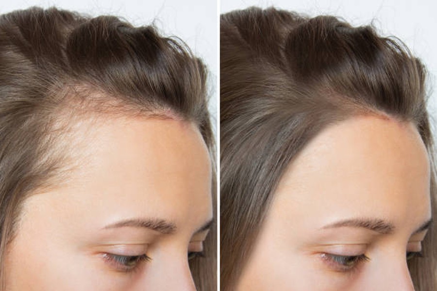 Hair Growth